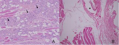 Imaging Findings From Different Pathological Types of Oral and Maxillofacial Intramuscular Hemangiomas for Selecting Optimum Management